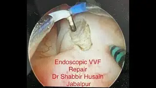Endoscopic VVF Repair - Dr Shabbir Husain , Jabalpur