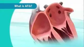 An overview of Atrial Fibrillation