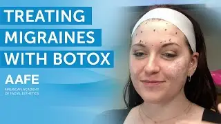 Using Botox to Treat Migraines After YEARS of Pain! | AAFE