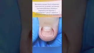 #медицинскийпедикюр #педикюр #ногти #лечениеногтей #грибок #грибокногтей