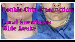 Double Chin Liposuction Quick Procedure Video--Local Anesthesia, Wide Awake