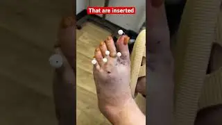 FOOT PIN CUSHION! 😱 NO MORE CALLUSES! 