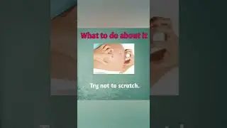 5 Easy Ways Relieve Itchiness During Pregnancy #health #shorts #ytshorts #pragnancy #whatsappstatus