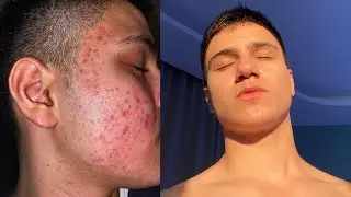 How I Conquered Acne: My One Year Journey