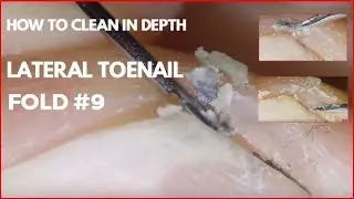 How to clean in depth lateral toenail fold #9