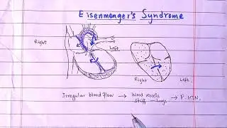 Eisenmenger syndrome ; What will Happen If Blood Flows From Right to Left Heart ?