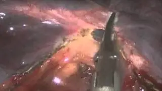 Uniportal Middle Lobectomy after Prior Right Upper Lobectomy