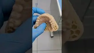 Примерка зубов на верхней челюсти на 8 имплантатах. Имплантация зубов.