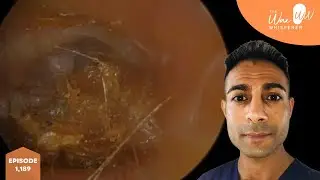 1,189 - Severely Sucked in Eardrum Ear Wax Removal
