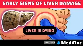 LIVER is DYING ! 10 Weird Signs Of LIVER Damage | Liver Damage Signs and Symptoms
