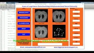 Detection Of Lung Cancer Types Using CNN Matlab Project With Source Code Lung Cancer Classification