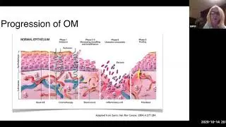 Managing Oral Mucositis with PBM