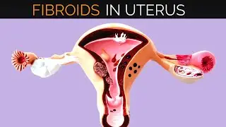 Uterine Fibroids Treatment | Fibroids Causes, symptoms and treatment |