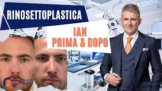 Ian: La Mia Esperienza con la Rinosettoplastica