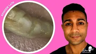 1,470 - Caterpillar Epidermal Plug Removed from Ear, Rai Curette, NMFs, Corneocytes & NEW POLL!