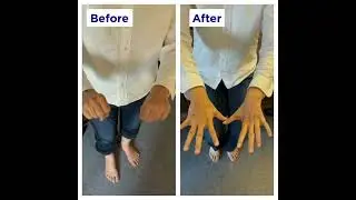 CMT(Charcot-Marie-Tooth disease) treatment record