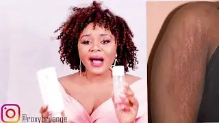 How To Get Rid Of Stretch Marks/ How To Remove Stretch Marks/Bio Oil Review