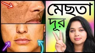 ✔ মেছতা দূর করার বৈজ্ঞানিক উপায় । How to Treat MELASMA?
