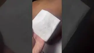 Acne back facial