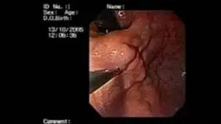 Glue injection of gastric varices
