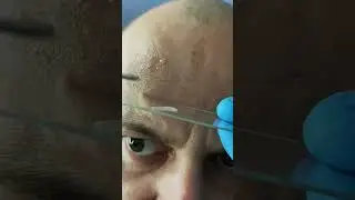 ГНОЙ ИЗ ПРЫЩА ПОД МИКРОСКОПОМ
