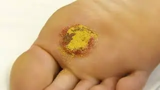 IODOSORB 0.9% Cadexomer Iodine Application - Diabetic Foot Ulcer