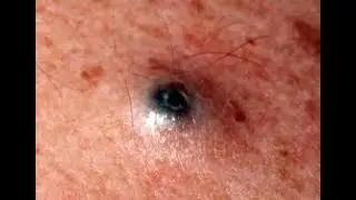 ТОП самых больших прыщей
