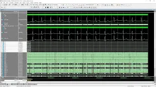 High Performance FIR and IIR Filters Based on FPGA for 16 Hz Signal Processing