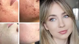 HOW I CLEARED MY HORMONAL ACNE NATURALLY 2020 // FAST RESULTS TO CLEAR YOUR SKIN