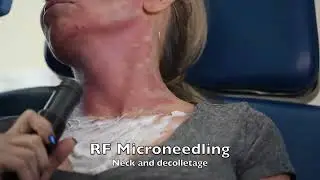 Genius RF Microneeedling neck decolletage H