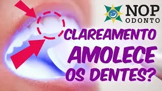 Clareamento amolece o dente? + Tudo sobre Clareamento Dental.