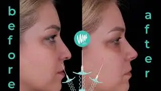 Dr. Ökkeş ŞİMŞEK / New Misko ile Cerrahi Olmayan Septum Greft Uygulaması - Bolat Medikal