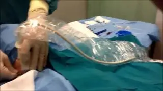 Certofix® CVC Tecnica ECG