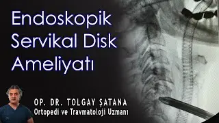 Endoskopik Servikal Disk Ameliyatı (Kapalı Boyun Fıtığı Ameliyatı)