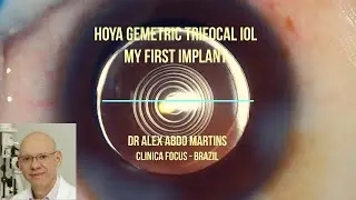 HOYA GEMETRIC TRIFOCAL IOL: MY FIRST IMPLANT