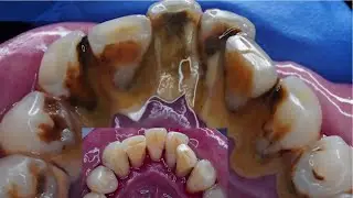 Gingival Inflammation Caused By Bacterial Plaque From Massive Tartar - Remove Tartar