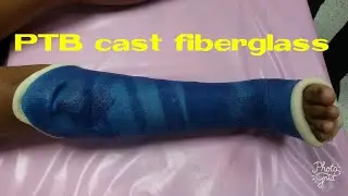 Application PTB cast fiberglass by RAKE Krittanai