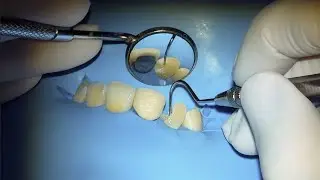 Class IV Fracture tooth repair with Composite