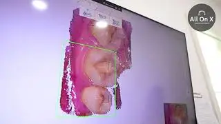 All On X Dental Studio Intra oral 3D Scanner