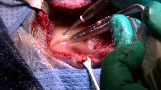 Artz - Cochlear implant Surgery - Gregory J. Artz MD