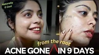 My *ZERO COST* 9-DAY Acne Experiment Changed Everything | Get rid of acne naturally without products