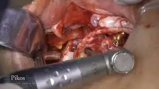 Digitally Planned Quad Zygomatic Implant Case