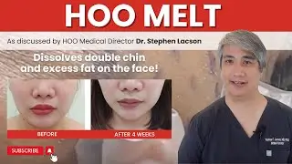 FACE NADE MESOLIPO FOR FACIAL CONTOURING AND DISSOLVING LOCALIZED FAT