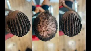 MIRACULOUS Braids over Baldness # | My Grip Game