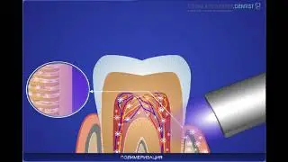 Лечение повышенной чувствительности зубов  Профилактика кариеса