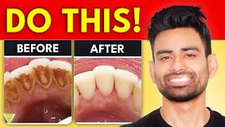 How to Remove Dental Plaque & Prevent Cavities?
