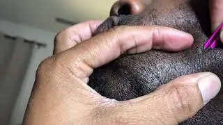 Ingrown Hairs | Picking My Husbands Face!