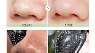easy way to remove Blackheads from Nose at home remedies| Priya Creations|