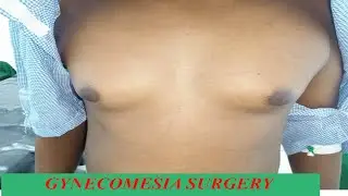 GYNECOMESTIA SURGERY LIPOSUCTION QALIINKA NAASA BARARKA RAGA
