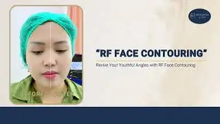 Rf Face Contouring